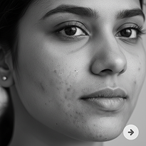 ACNE-PRONE SKIN